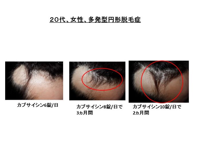 円形脱毛症　病院